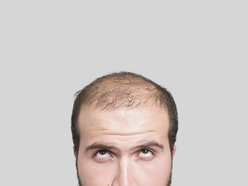 what causes hair loss