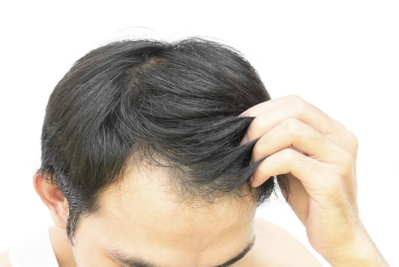 Hair Loss: Why It's Happening to Generation Y