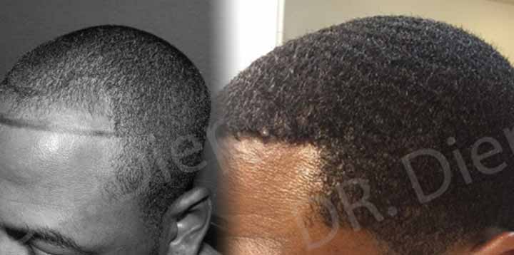 What to Know About African American Hair Transplants