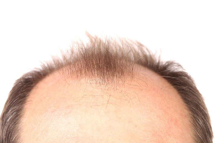 Early Hair Loss: Fact vs. Fiction