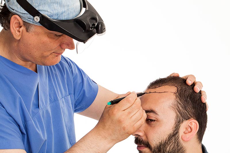 Do Hair Transplant Cause Damage to Existing Hair Follicles?