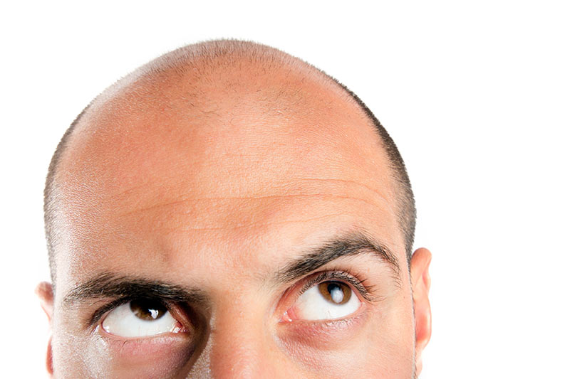 5 Common Myths About Hair Transplant Surgery