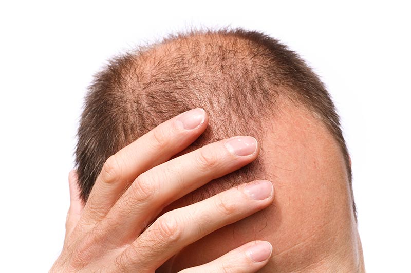 How and Why Men Go Bald