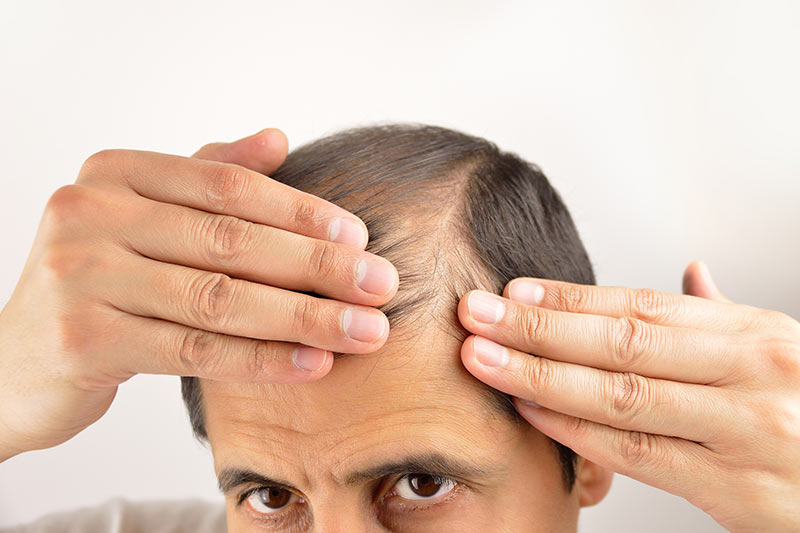 Best Treatments for Men's Hair Loss