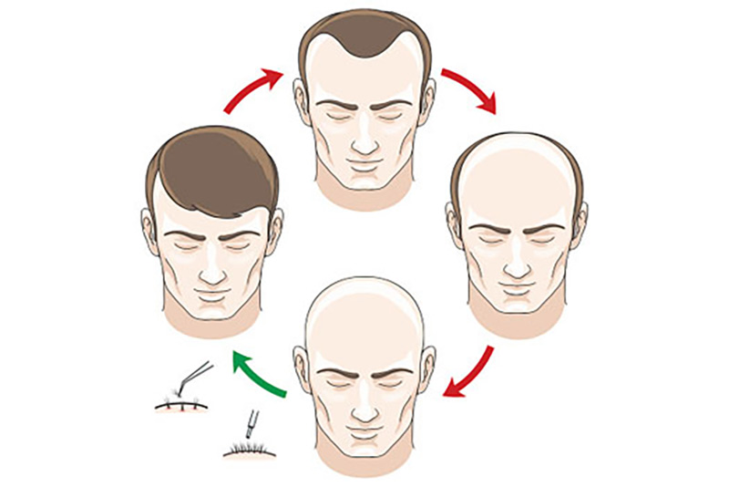 Los Gatos hair transplant 