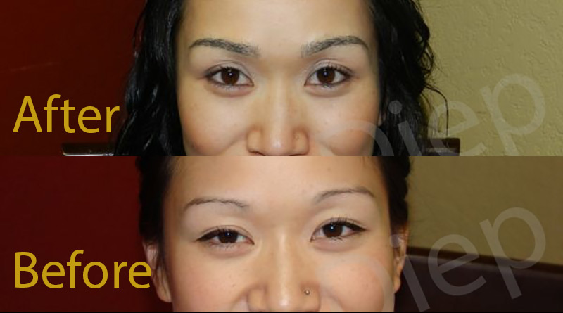  San Francisco eyebrow hair restoration surgery