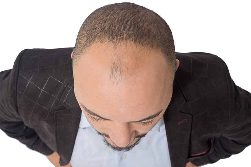 Men hair loss treatment. Hair transplant surgery.