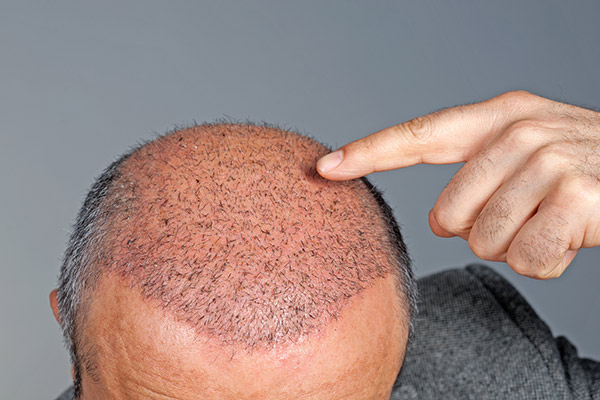 Reasons You Should Not Fear Hair Transplant Surgery