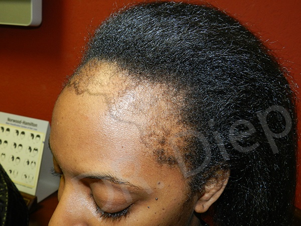 african american hair transplant san jose