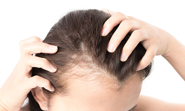 female hair loss from thyroid conditions