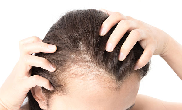 Hypothyroidism and hair deals loss