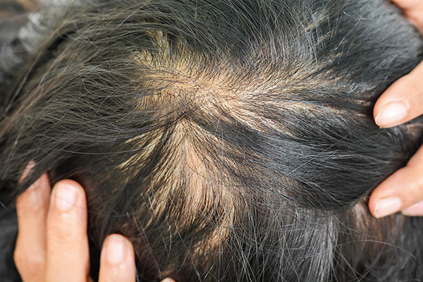 Stress and Hair Loss  Cosmedica Clinic  Dr Levent Acar