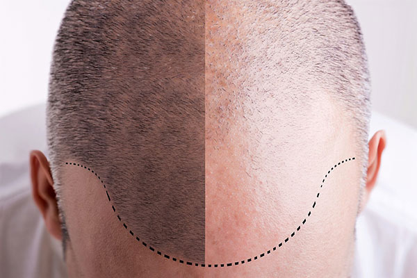 hairline surgery san francisco