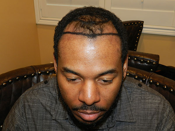 What Causes a Receding Hairline?
