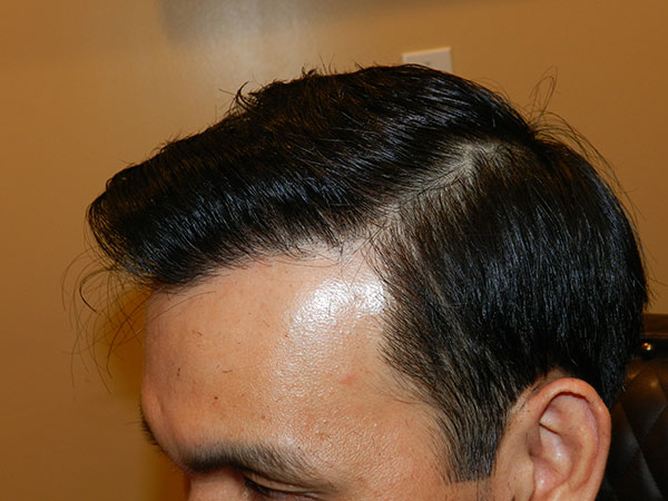 after FUE Hair Restoration at mhta clinic