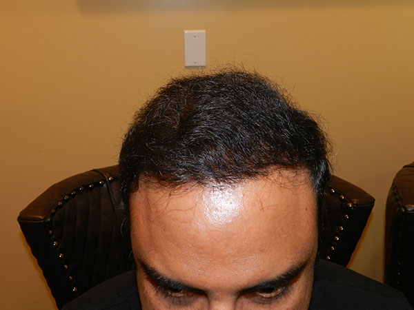 after hairline surgery san francisco