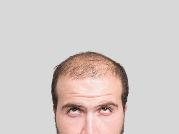 7 Clear Signs of Male Balding