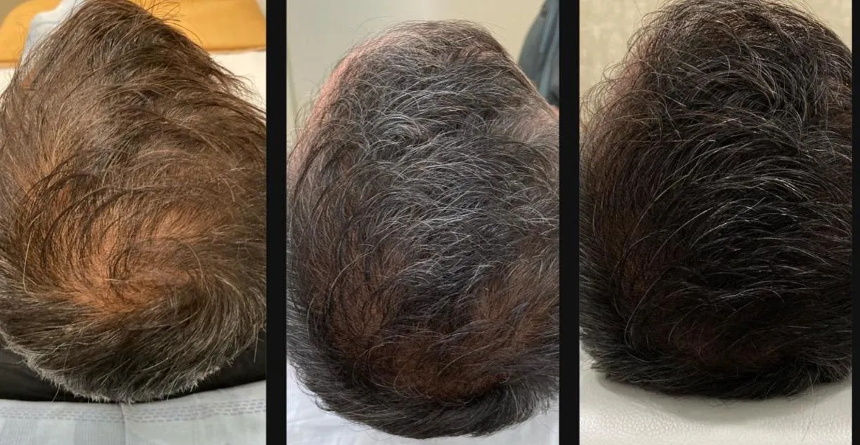 Before and after hair restoration results showing improved scalp coverage