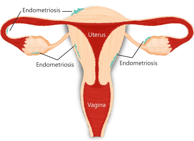 About endometriosis