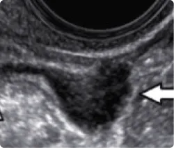 Endometriosis and IVF treatment in Ahmedabad