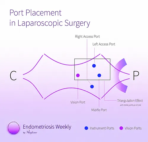 Laparoscopic Excision Surgery