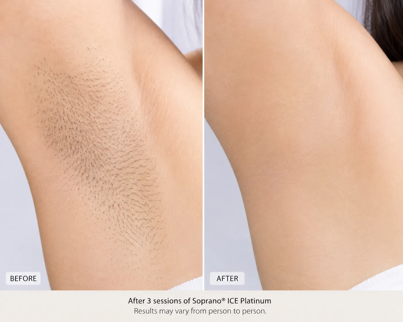 Before and after laser hair reduction results, underarm