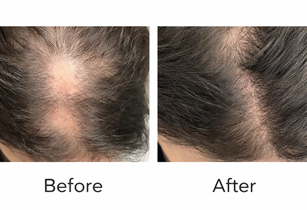 Combination hair therapy plan at Mayflower Aesthetics