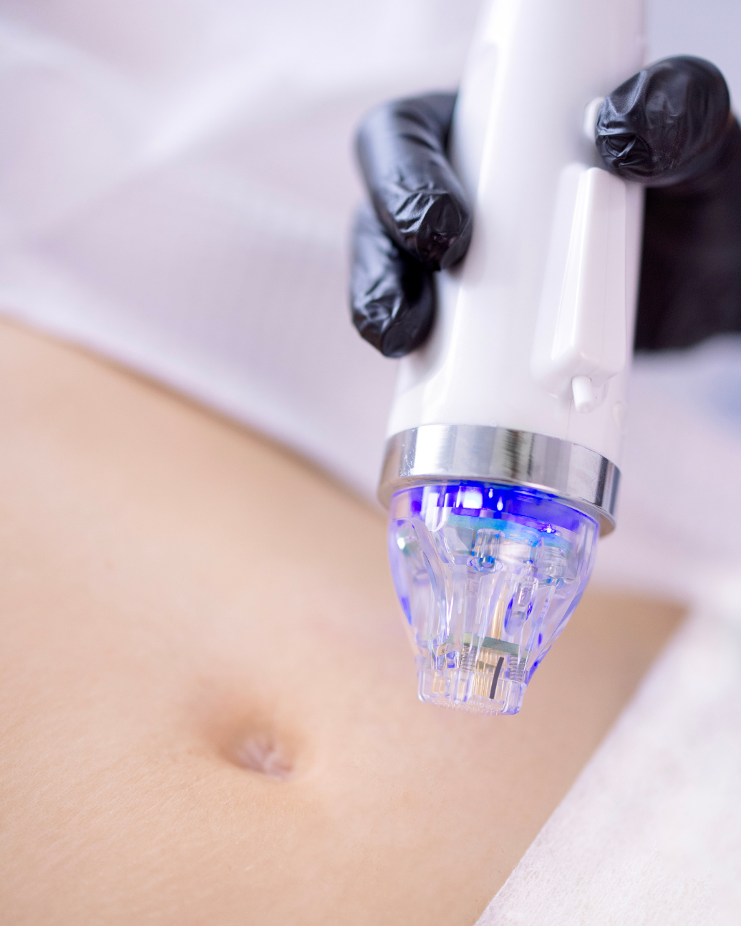 Monopolar RF Skin Tightening in Ahmedabad