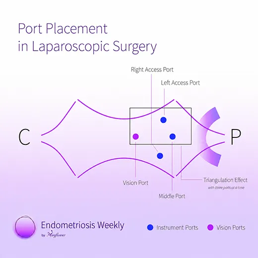 Minimally Invasive Surgery