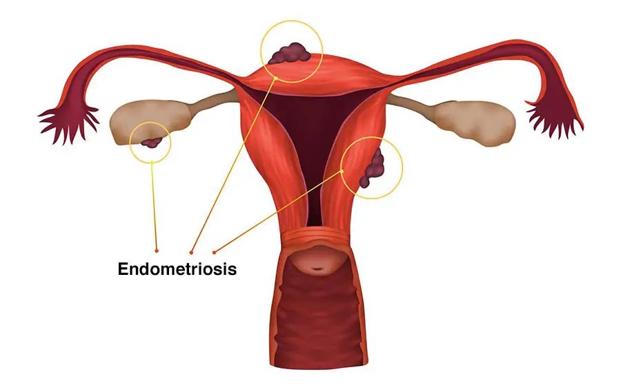 Endometriosis symptoms – causes, signs & diagnosis