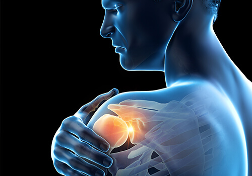 Benefits of ACE/IR for Frozen Shoulder