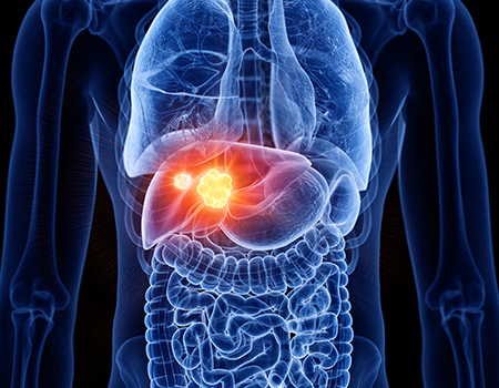 Liver Cancer