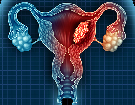 Uterine Fibroid Embolization