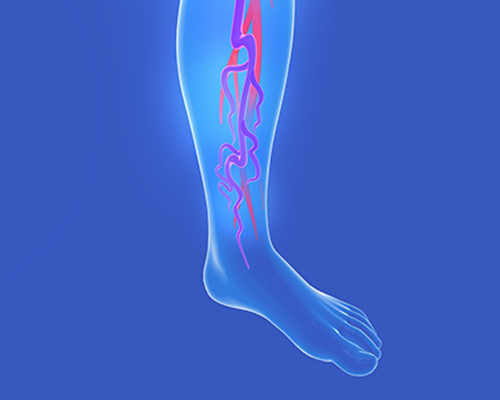 Symptoms and Diagnosis of Varicose Veins