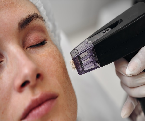 Microneedling