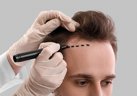 Men Hair Transplant