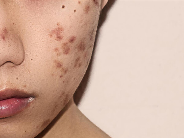 Acne vulgaris and complications