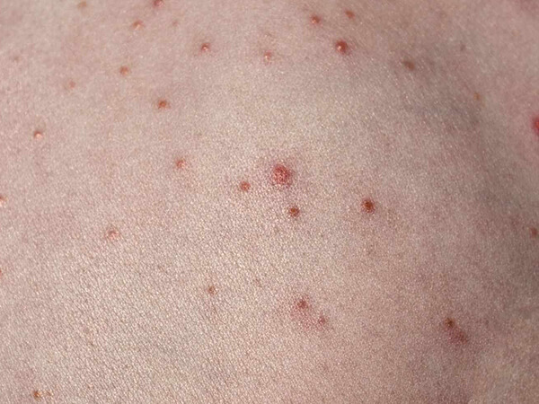 Bacterial infections of skin