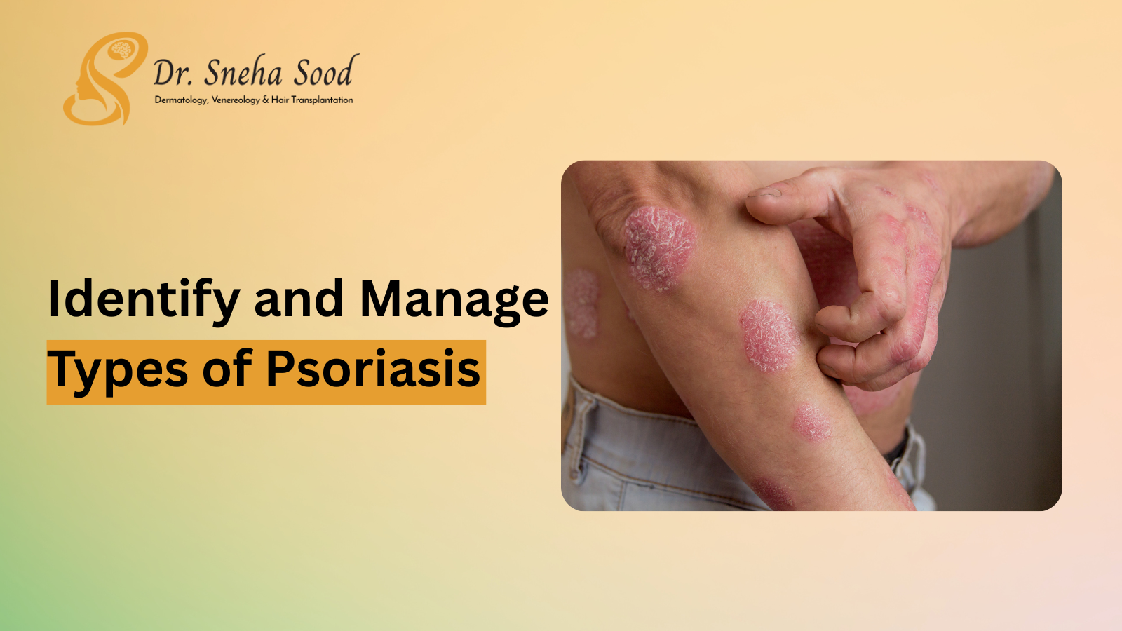 Identify and Manage Types of Psoriasis