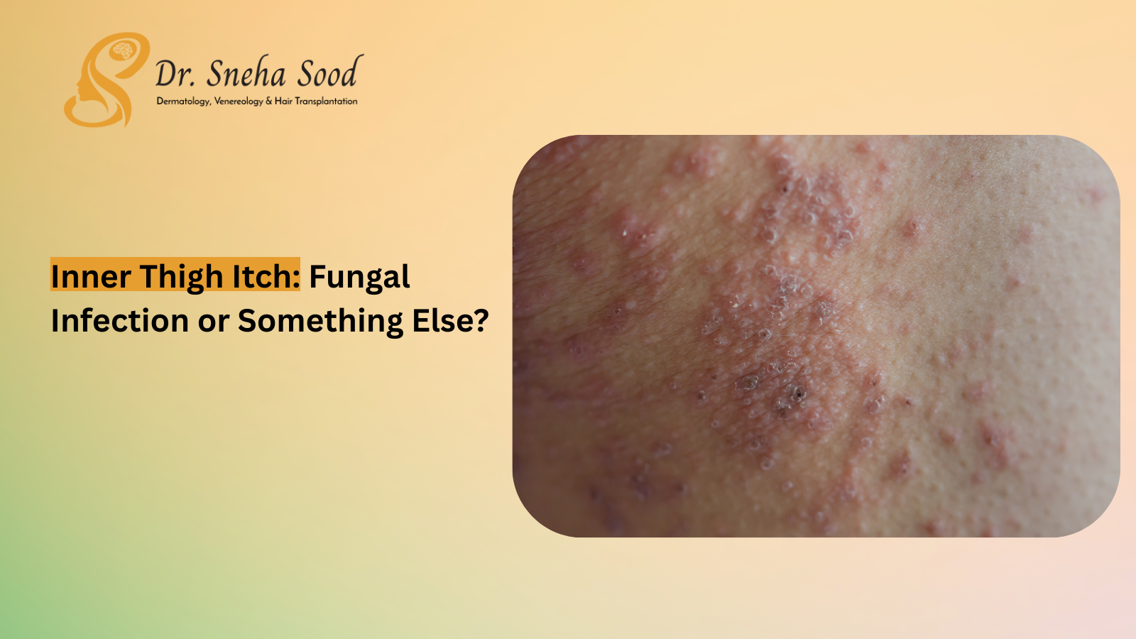 Does an Inner Thigh Itch Mean a Fungal Infection or Something Else?