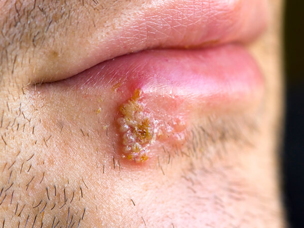Herpes Infections