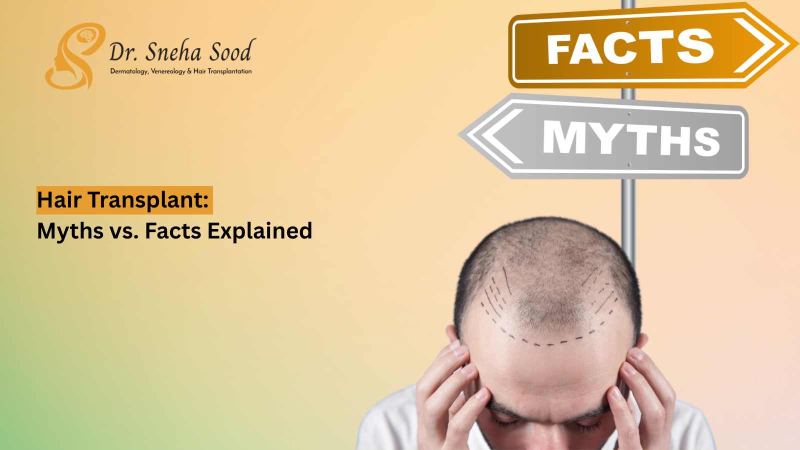 Hair Transplant Facts and Myths: What Most People Get Wrong About Hair Restoration