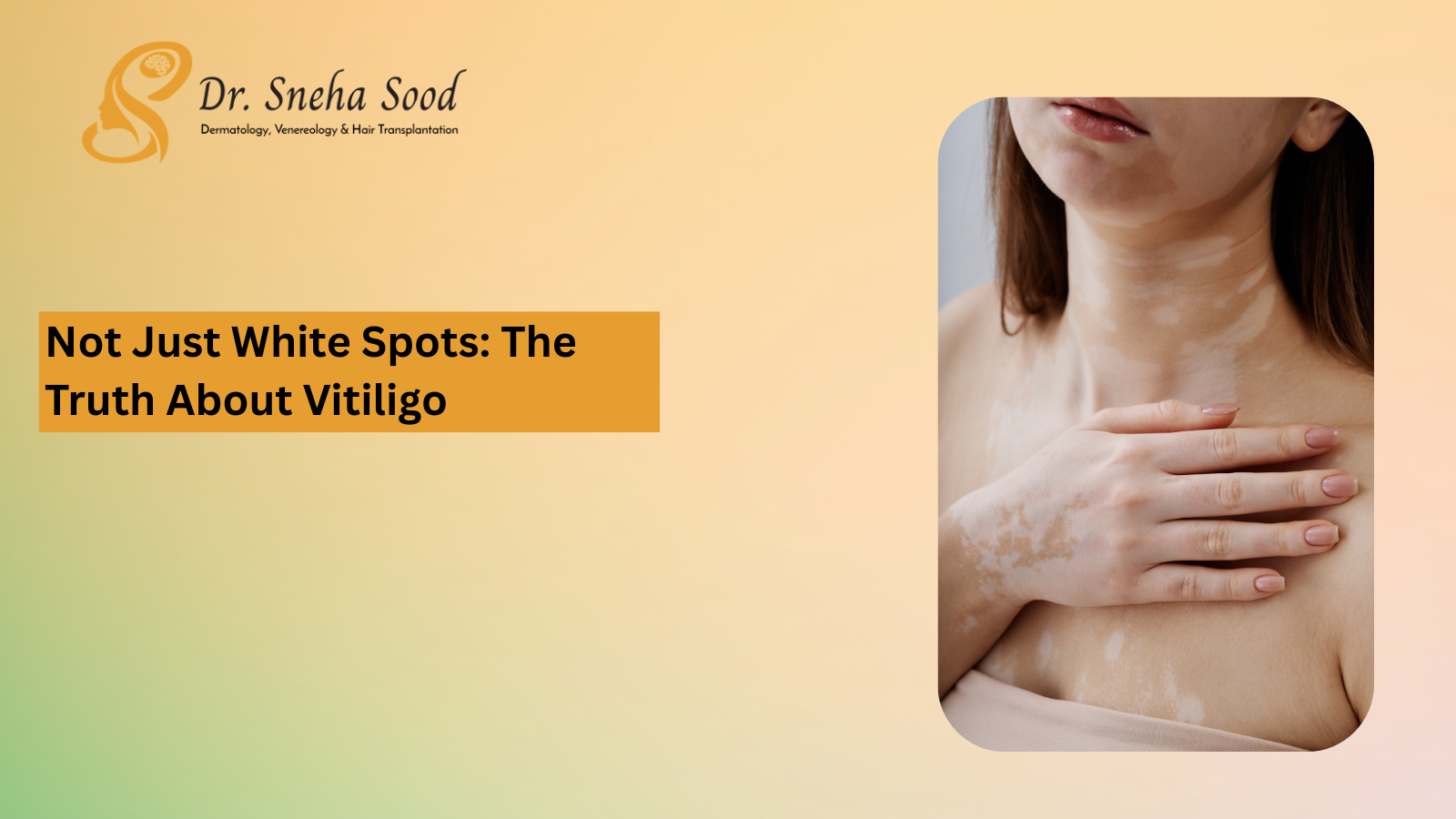 Vitiligo Treatment Bangalore Vitiligo white patches treatment options at dermatologist clinic Bangalore