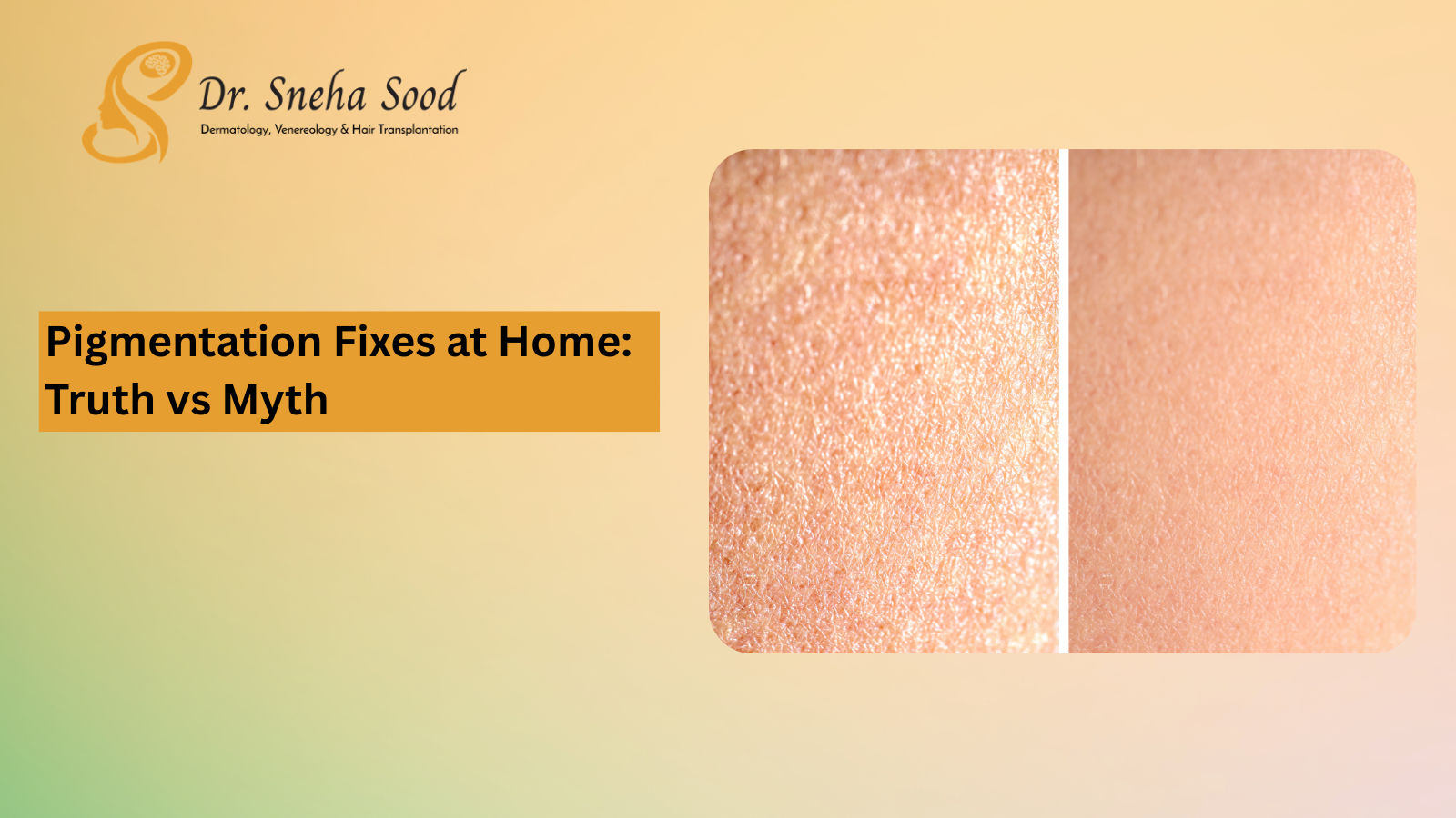 Pigmentation home remedies vs clinical treatment dermatologist Bangalore