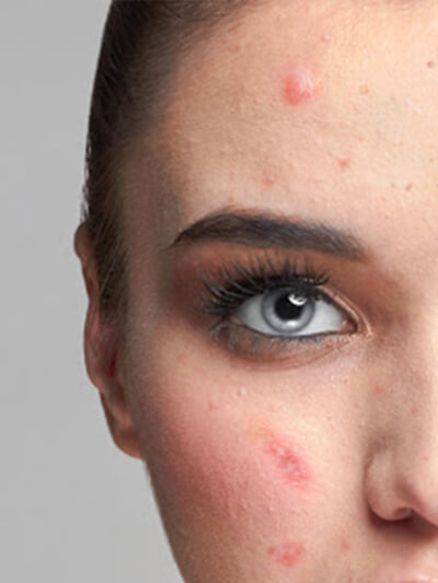 PRP for acne scars before