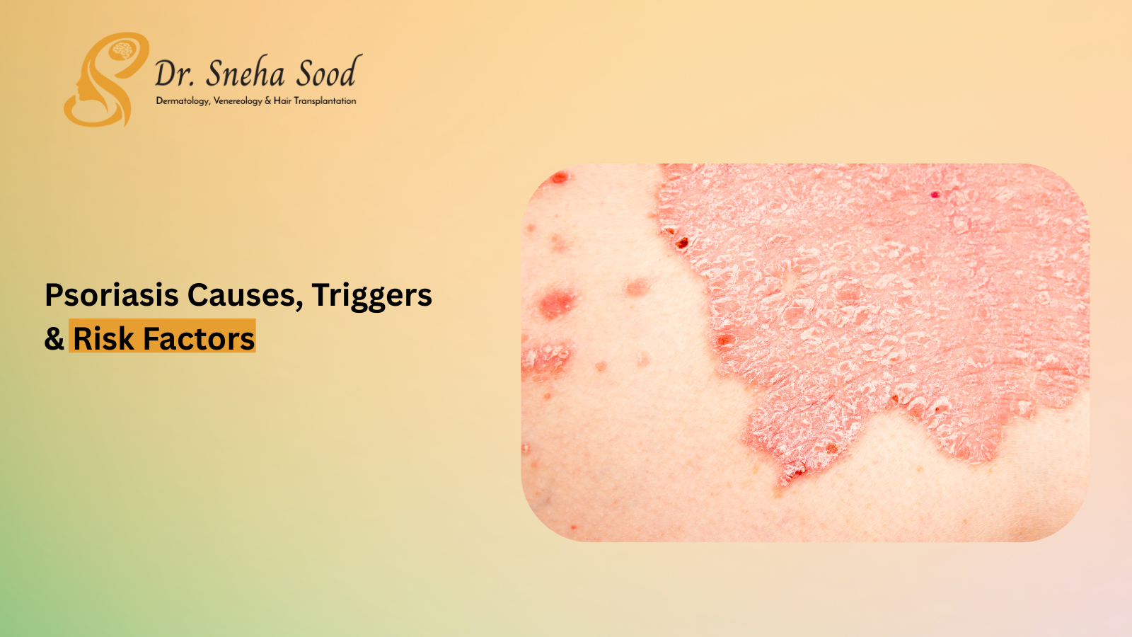 What Causes Psoriasis? Understanding Psoriasis Triggers and Risk Factors