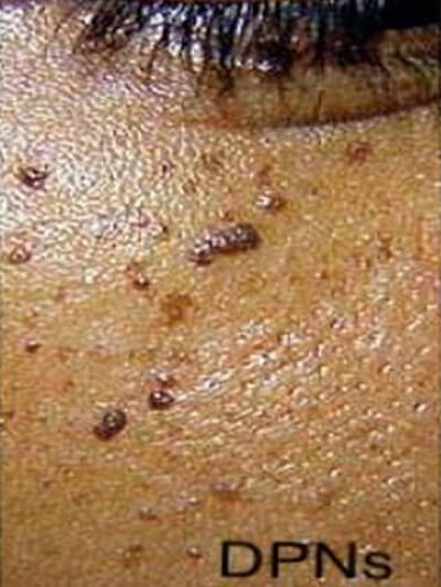 Skin tag after