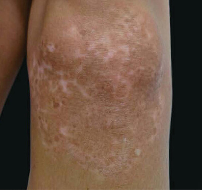 Non cultured epidermal cell suspension treatment after