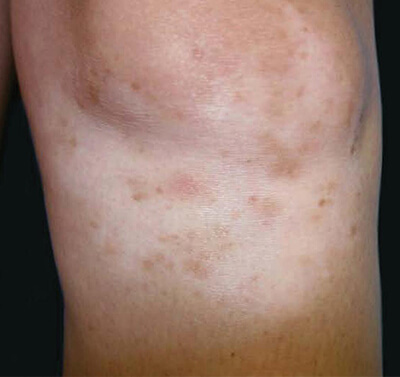 Non cultured epidermal cell suspension treatment before