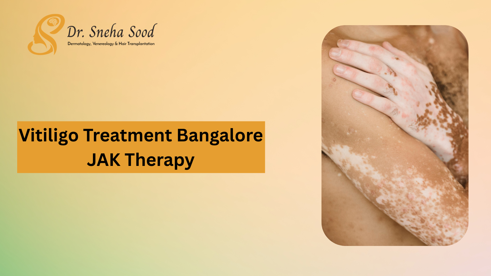 Vitiligo Treatment Bangalore JAK Therapy